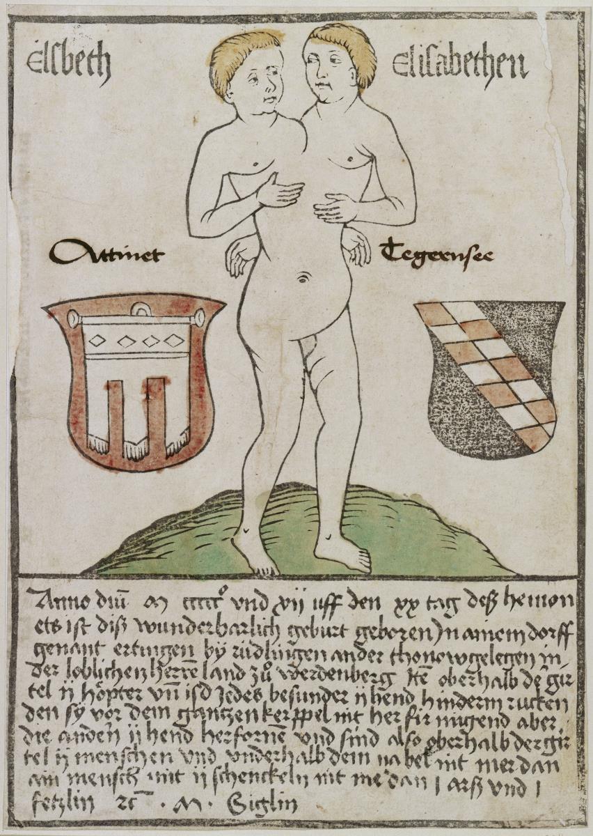 Siamesische Zwillinge von Ertingen